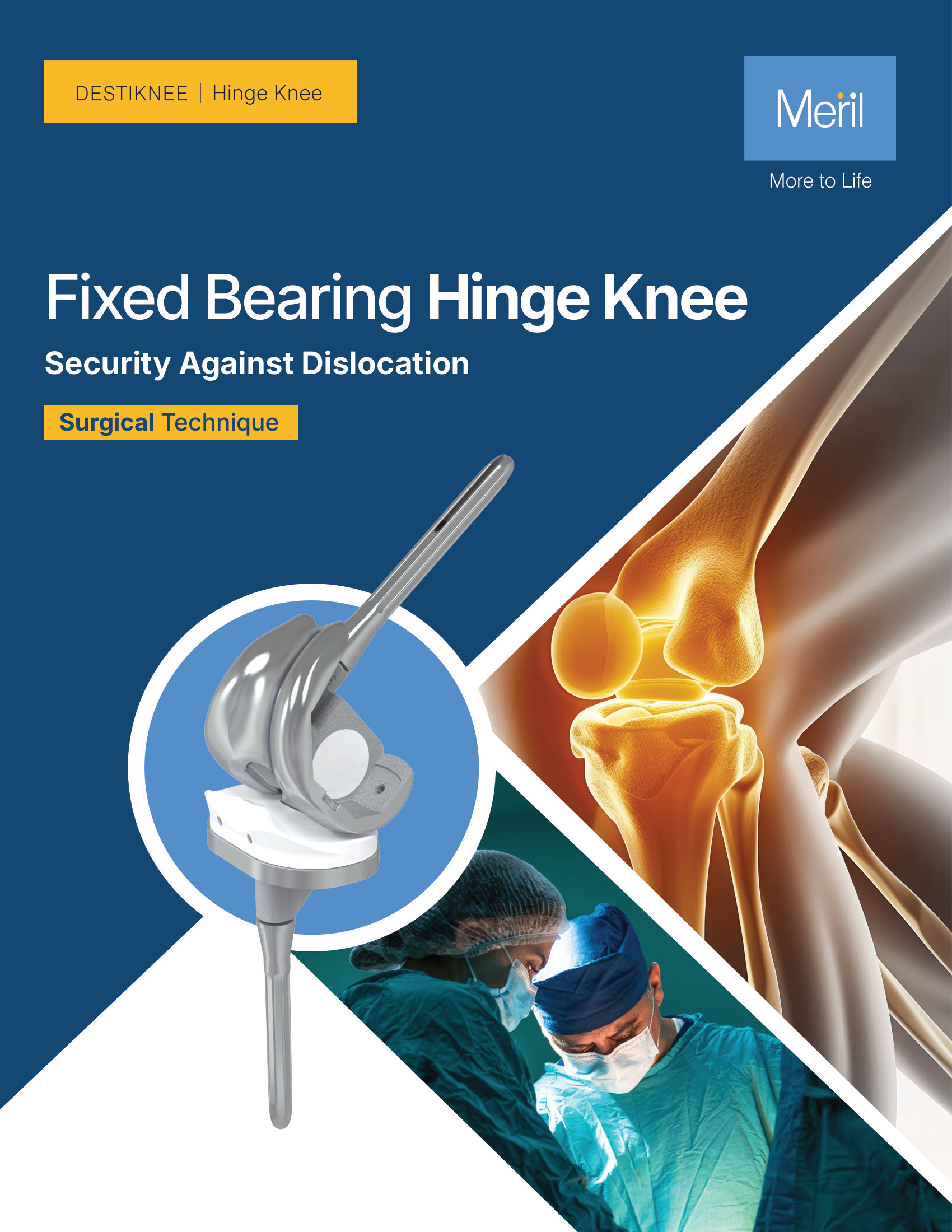 Hinge Knee Femoral Augment Posterior